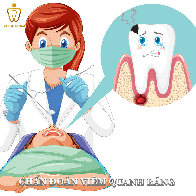 Viêm Quanh Răng Là Gì: Cẩm Nang Toàn Diện Về Nguyên Nhân, Triệu Chứng Và Giải Pháp Điều Trị Triệt Để 3 viêm quanh chóp răng