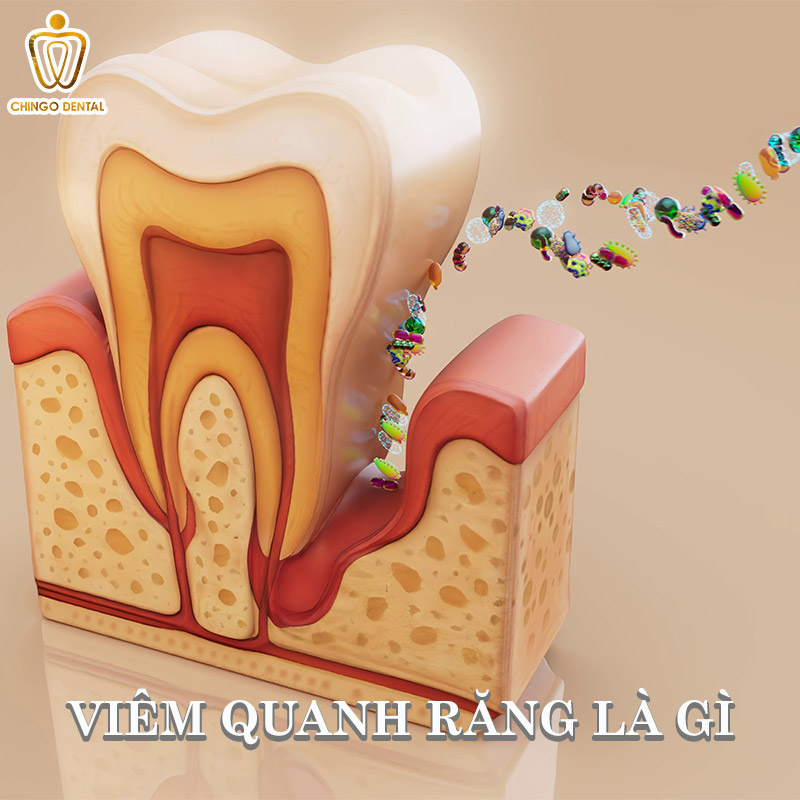 Viêm Quanh Răng Là Gì: Cẩm Nang Toàn Diện Về Nguyên Nhân, Triệu Chứng Và Giải Pháp Điều Trị Triệt Để 1 Viêm quanh răng là gì?