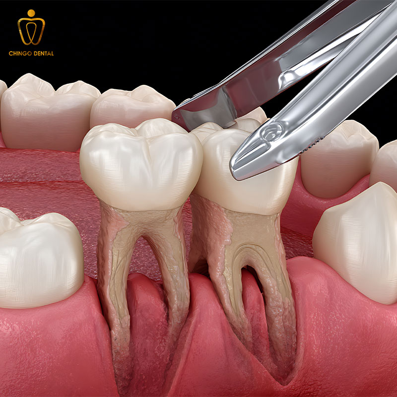 Nhổ Răng Vĩnh Viễn Có Đau Không? Sau Bao Lâu Nên Trồng Lại 1 cách nhổ răng vĩnh viễn