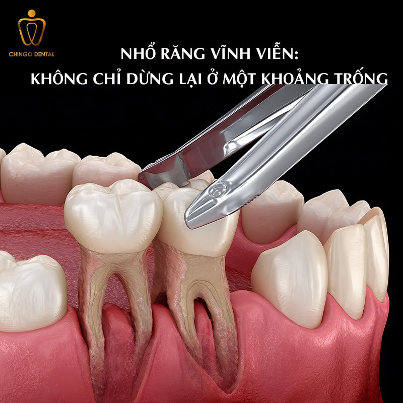 Nhổ Răng Vĩnh Viễn Có Đau Không? Sau Bao Lâu Nên Trồng Lại 3 Khi nào phải nhổ răng vĩnh viễn?