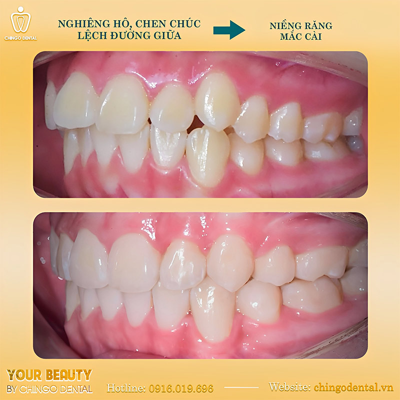 Lợi ích của việc niềng răng sớm