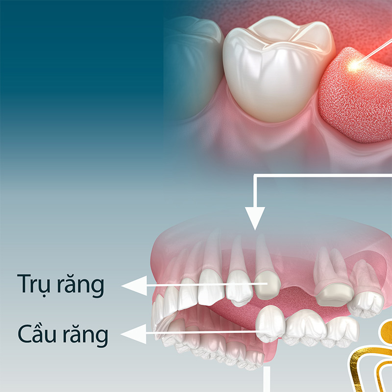 nhổ răng vĩnh viễn bao nhiêu tiền
