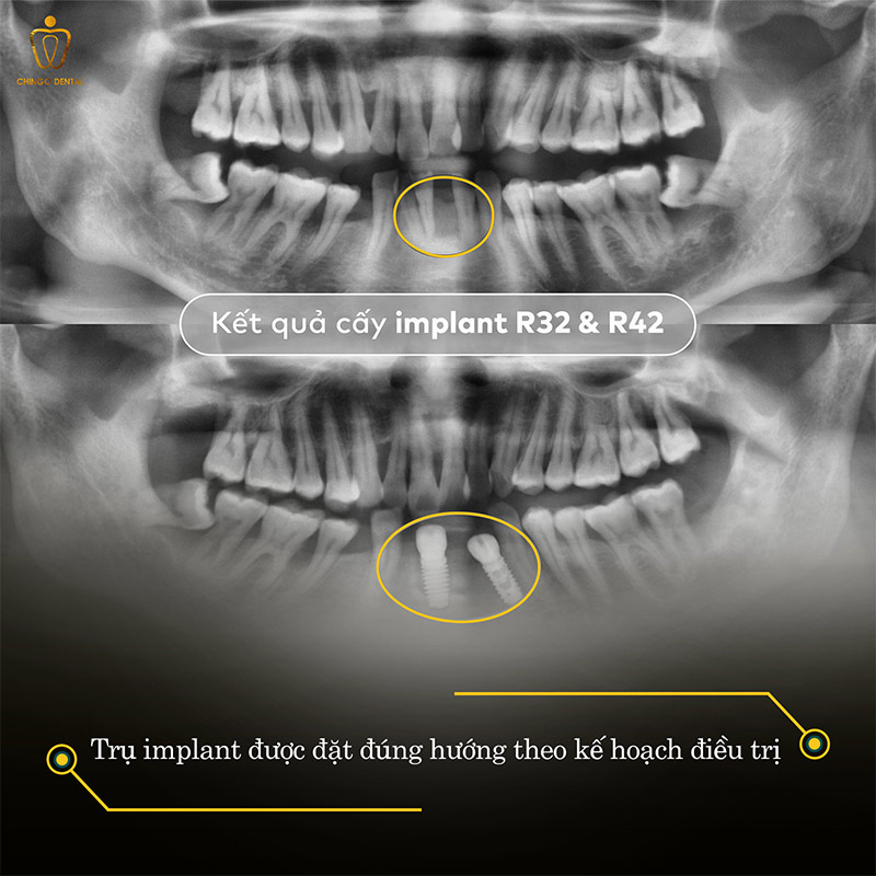 Mất Một Chiếc Răng – Câu Chuyện Không Chỉ Dừng Lại Ở Một Khoảng Trống 3 nhổ răng vĩnh viễn có mọc lại không