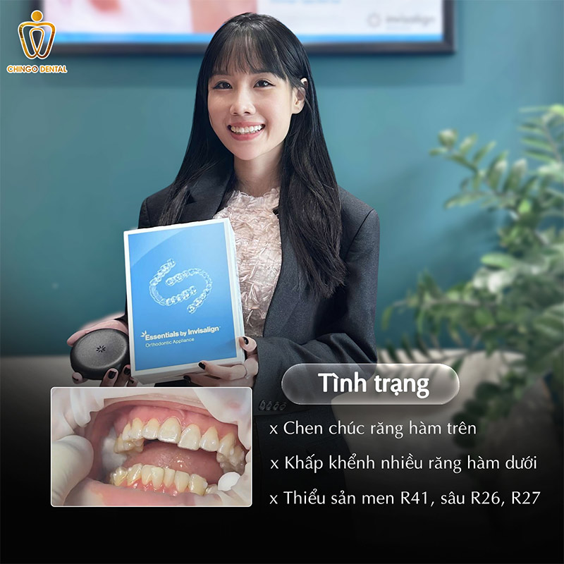 Niềng Răng Là Gì? Chi Phí Và Những Câu Hỏi Thường Gặp Về Niềng Răng 5 niềng răng invisalign Đà Nẵng