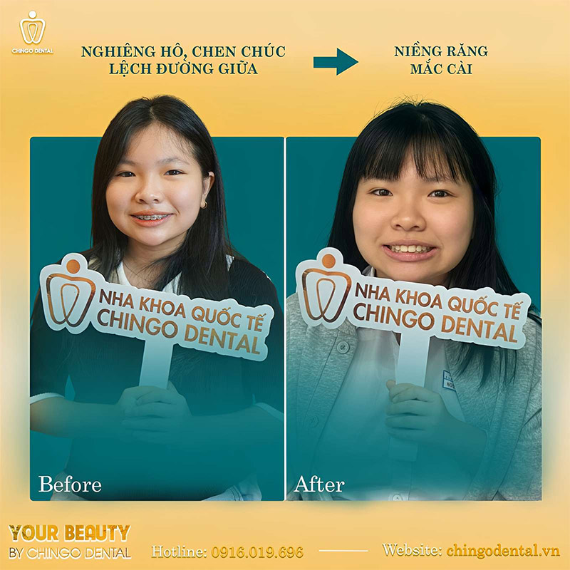 Niềng Răng Là Gì? Chi Phí Và Những Câu Hỏi Thường Gặp Về Niềng Răng 16 niềng răng uy tín Đà Nẵng