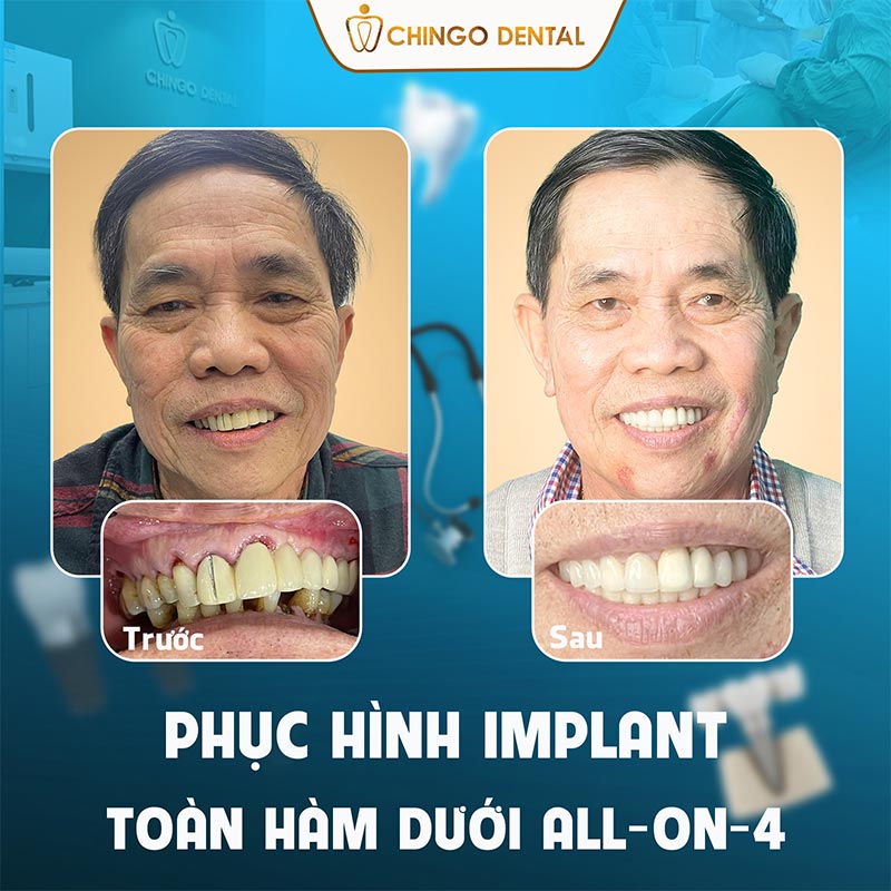 Trồng Răng Implant Là Gì? Ưu Nhược Điểm Ra Sao? Quy Trình Và Những Điều Cần Lưu Ý 9 trồng răng implant