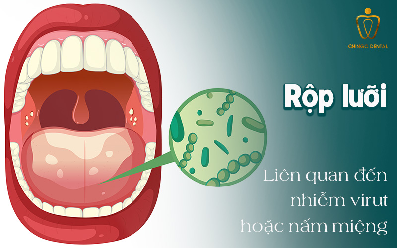 Cách Trị Nhiệt Miệng Trong 1 Ngày: Phương Pháp Nhanh Nhất Từ Dân Gian Đến Thuốc Đặc Trị 5 cách trị lở lưỡi nhanh nhất