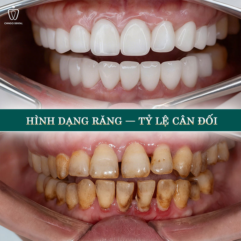 Răng Đẹp Là Như Thế Nào? 6 Tiêu Chuẩn Hàm Răng Đẹp Tự Nhiên Bạn Cần Biết 2 hàm răng chuẩn