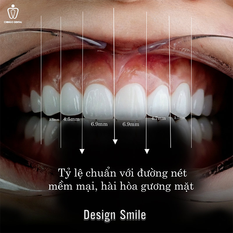 Răng Đẹp Là Như Thế Nào? 6 Tiêu Chuẩn Hàm Răng Đẹp Tự Nhiên Bạn Cần Biết 1 hàm răng đẹp tự nhiên