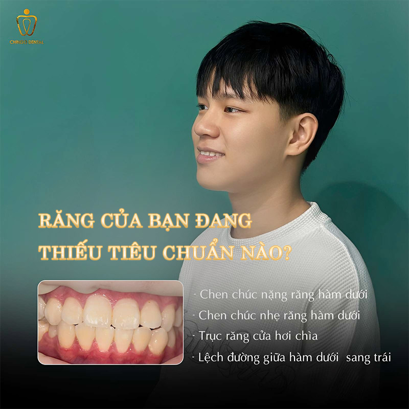 Răng Đẹp Là Như Thế Nào? 6 Tiêu Chuẩn Hàm Răng Đẹp Tự Nhiên Bạn Cần Biết 5 hàm răng đẹp