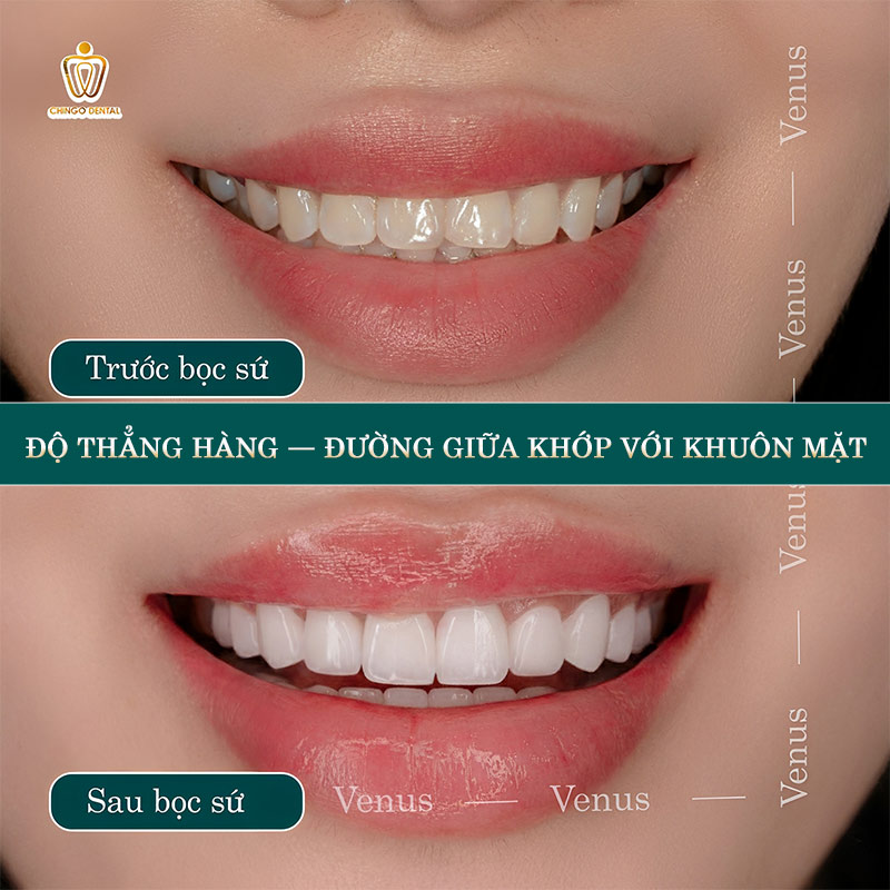 Răng Đẹp Là Như Thế Nào? 6 Tiêu Chuẩn Hàm Răng Đẹp Tự Nhiên Bạn Cần Biết 3 hàm răng tiêu chuẩn