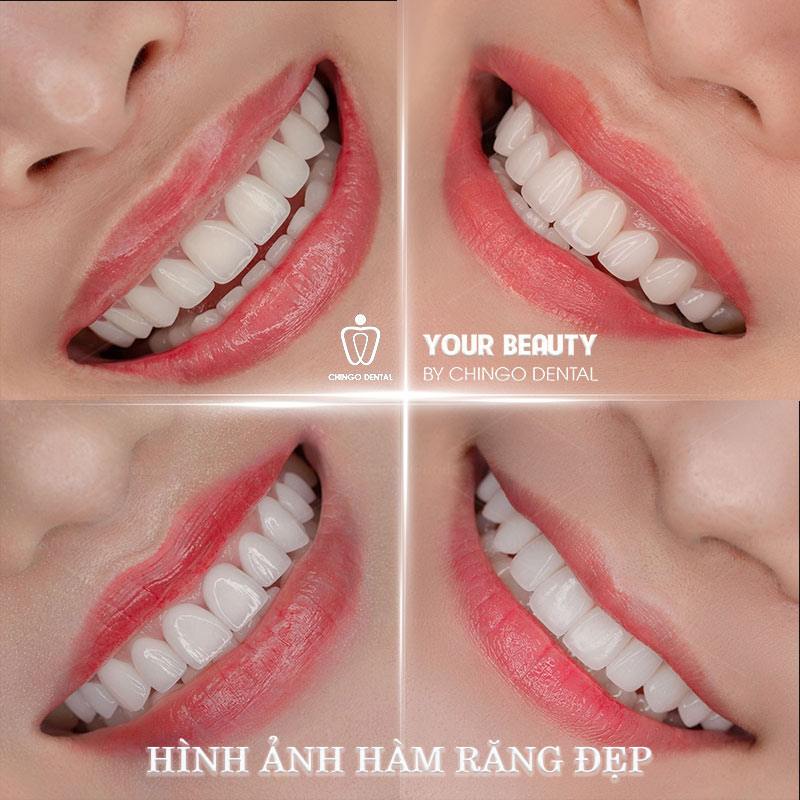 Răng Đẹp Là Như Thế Nào? 6 Tiêu Chuẩn Hàm Răng Đẹp Tự Nhiên Bạn Cần Biết 4 hình răng đẹp