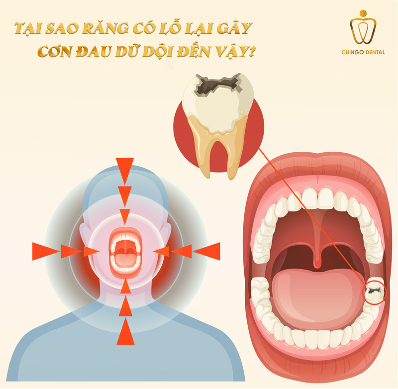 Cách Trị Nhức Răng Có Lỗ: Giảm Đau Nhanh Tại Nhà Và Biết Khi Nào Cần Gặp Nha Sĩ 1 mẹo trị nhức răng