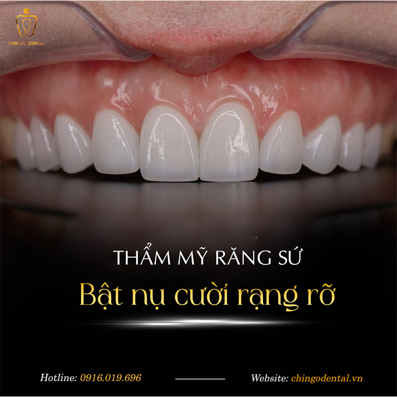 Bọc răng sứ 3 Bọc răng sứ thẩm mỹ