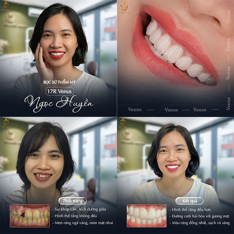 Răng Sứ Venus Là Gì? Giá, Phân Loại Và Có Tốt Không - Giải Đáp Toàn Diện Từ Chingo Dental 5 răng sứ venus có mấy loại