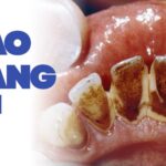 bị cao răng nặng
