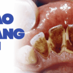 Bị Cao Răng Nặng - Nguyên Nhân, Biến Chứng Và Giải Pháp Loại Bỏ Triệt Để Từ Chuyên Gia bị cao răng nặng