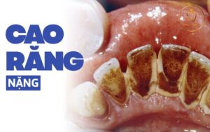bị cao răng nặng