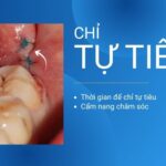 Chỉ tự tiêu nha khoa - thời gian tiêu và cẩm nang chăm sóc từ chuyên gia chỉ tự tiêu nha khoa