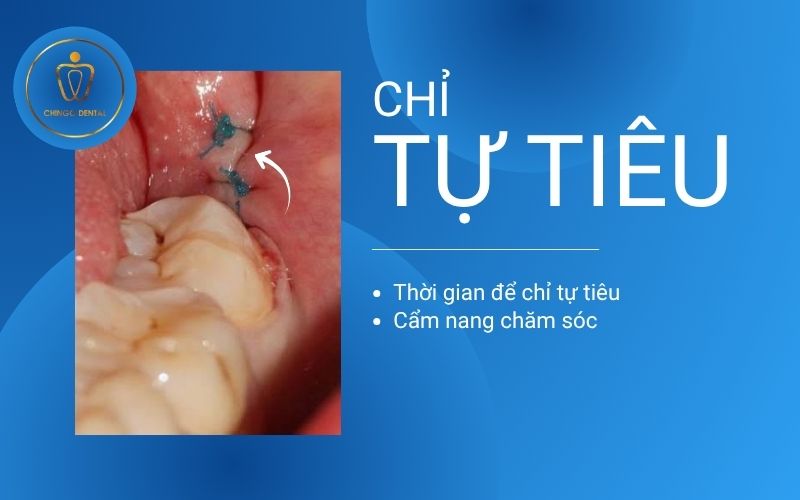 Chỉ tự tiêu nha khoa - thời gian tiêu và cẩm nang chăm sóc từ chuyên gia 1 chỉ tự tiêu nha khoa