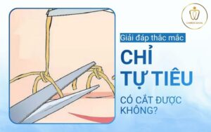 Chỉ tự tiêu nha khoa - thời gian tiêu và cẩm nang chăm sóc từ chuyên gia 4 chỉ tự tiêu nha khoa