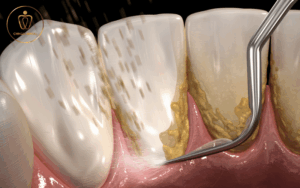 Bị Cao Răng Nặng - Nguyên Nhân, Biến Chứng Và Giải Pháp Loại Bỏ Triệt Để Từ Chuyên Gia 2 bị cao răng nặng
