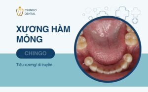 Xương Hàm Là Gì? Cấu Trúc Và Các Bệnh Lý Thường Gặp 4 xương hàm