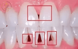 Bị Cao Răng Nặng - Nguyên Nhân, Biến Chứng Và Giải Pháp Loại Bỏ Triệt Để Từ Chuyên Gia 3 bị cao răng nặng