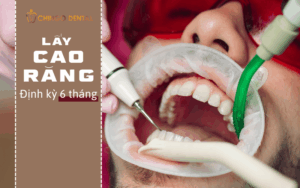 Bị Cao Răng Nặng - Nguyên Nhân, Biến Chứng Và Giải Pháp Loại Bỏ Triệt Để Từ Chuyên Gia 5 bị cao răng nặng