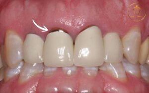 Chân răng sứ bị hôi - 5 nguyên nhân, dấu hiệu và cách khắc phục triệt để 2 chân răng sứ bị hôi