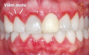 Chân răng sứ bị hôi - 5 nguyên nhân, dấu hiệu và cách khắc phục triệt để 3 chân răng sứ bị hôi