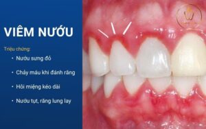 Chân răng sứ bị hôi - 5 nguyên nhân, dấu hiệu và cách khắc phục triệt để 3 răng sứ bị hôi