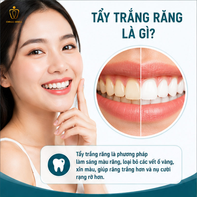 tẩy trắng răng là gì

