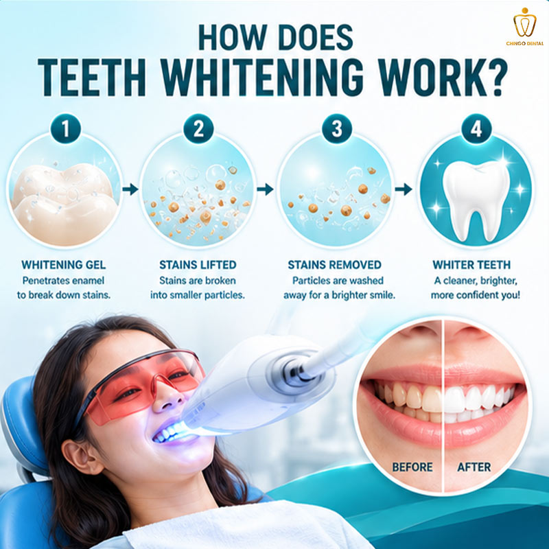 Teeth Whitening in Vietnam: Your Complete Guide to a Brighter, Confident Smile 2 teeth whitening near me