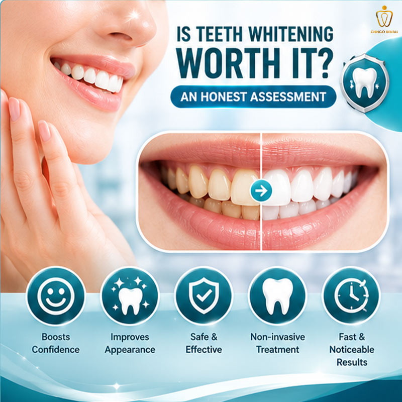 Teeth Whitening in Vietnam: Your Complete Guide to a Brighter, Confident Smile 3 teeth whitening services