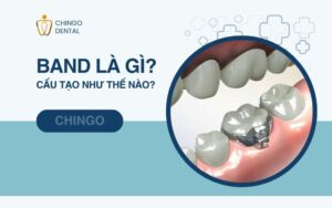 Band Là Gì? Gắn Band Niềng Răng Có Đau Không? 1 band là gì