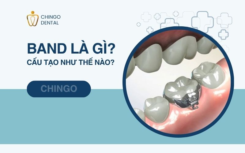 Band Là Gì? Gắn Band Niềng Răng Có Đau Không? 6 band là gì