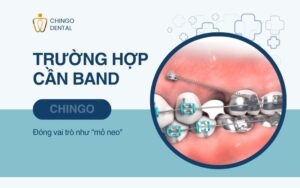 Band Là Gì? Gắn Band Niềng Răng Có Đau Không? 2 band là gì