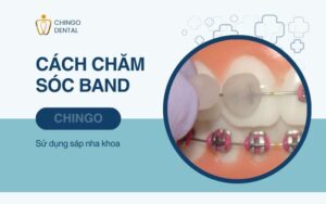 Band Là Gì? Gắn Band Niềng Răng Có Đau Không? 3 band là gì