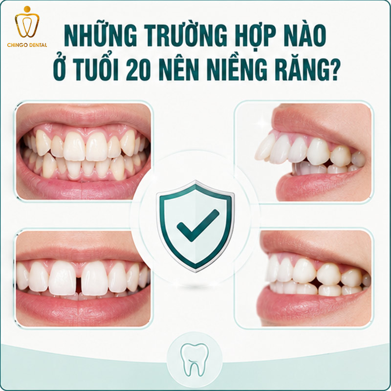 20 Tuổi Niềng Răng Bao Nhiêu Tiền? Bảng Giá & Giải Đáp Toàn Diện 2 20 tuổi niềng răng bao lâu