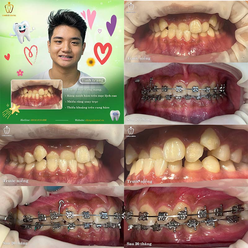 Niềng Răng Móm Trước Và Sau: Hình Ảnh Thực Tế & Quy Trình Đầy Đủ 5 ảnh trước và sau khi niềng răng