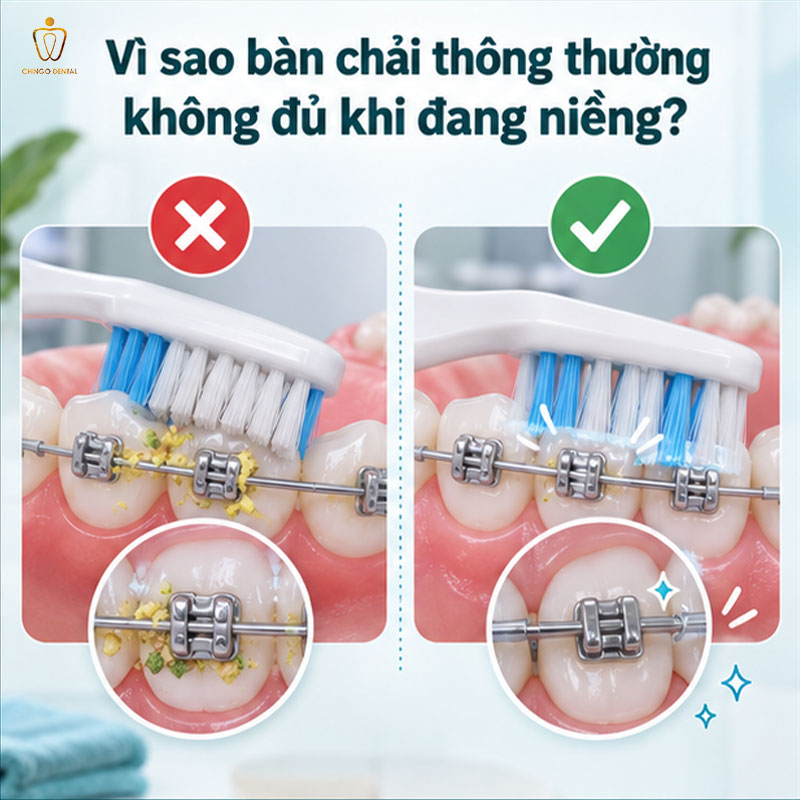 Bàn Chải Niềng Răng: Loại Nào Phù Hợp Và Cách Dùng Đúng Để Răng Luôn Sạch Trong Suốt Hành Trình Chỉnh Nha 2 bàn chải kẽ răng