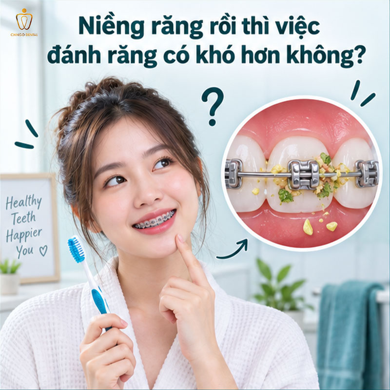 Bàn Chải Niềng Răng: Loại Nào Phù Hợp Và Cách Dùng Đúng Để Răng Luôn Sạch Trong Suốt Hành Trình Chỉnh Nha 1 bàn chải niềng răng
