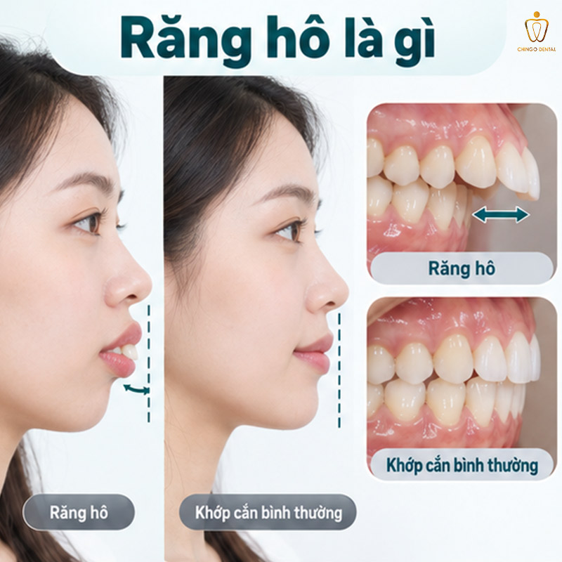 Các Giai Đoạn Niềng Răng Hô: Lộ Trình Chi Tiết Từng Bước Bạn Cần Biết 1 các giai đoạn niềng răng hô