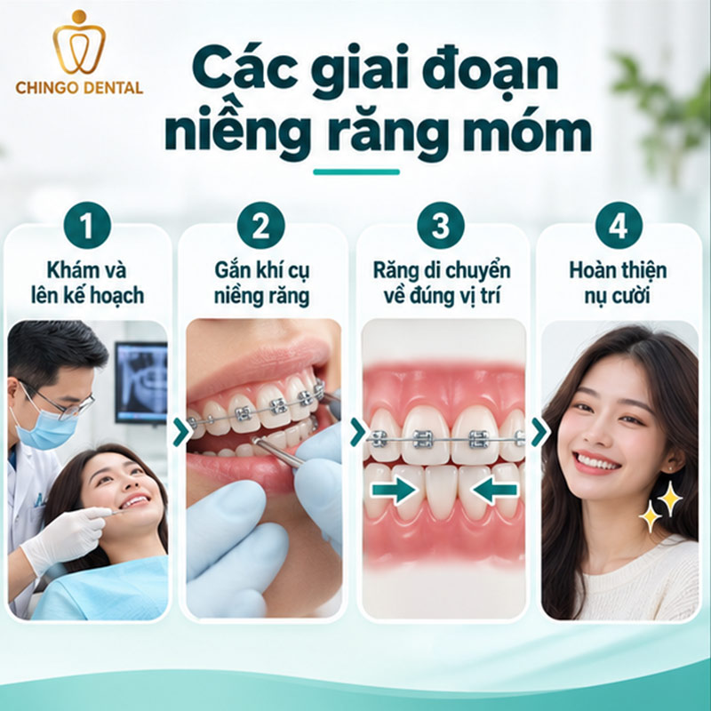 Niềng Răng Móm Trước Và Sau: Hình Ảnh Thực Tế & Quy Trình Đầy Đủ 7 các giai đoạn niềng răng móm