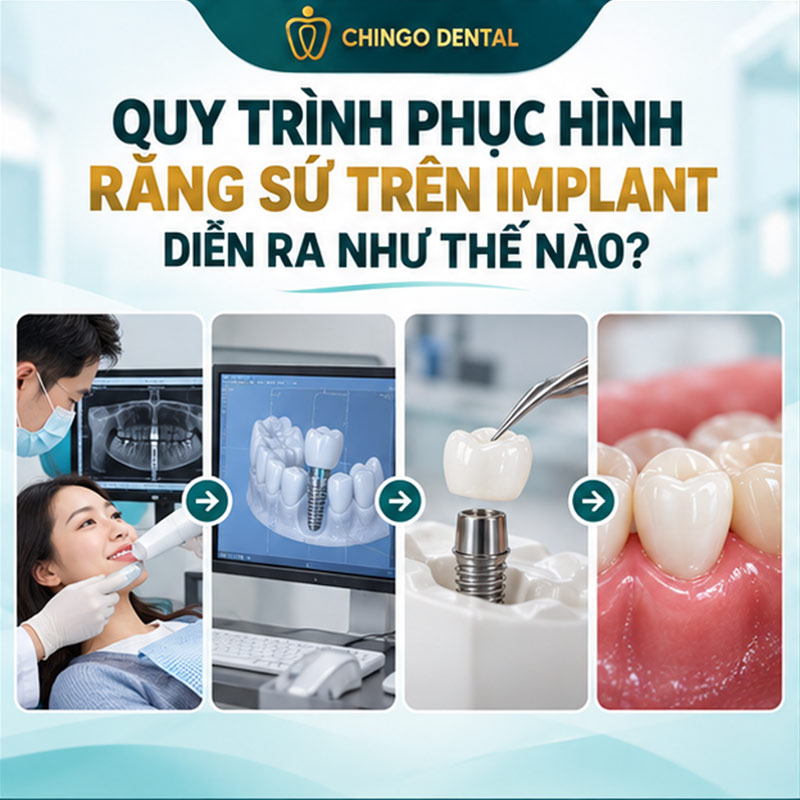Răng Sứ Trên Implant: Giải Pháp Phục Hình Mất Răng Bền Vững Nhất Hiện Nay 3 cách trồng răng sứ