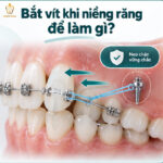 Bắt Vít Niềng Răng (Minivis) Là Gì? Có Đau Không & Chi Phí Bao Nhiêu? cắm vít niềng răng