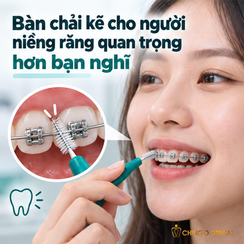 Bàn Chải Kẽ Răng Là Gì? Cách Dùng Đúng Và Lưu Ý Quan Trọng Cho Người Niềng 3 có nên dùng bàn chải kẽ răng