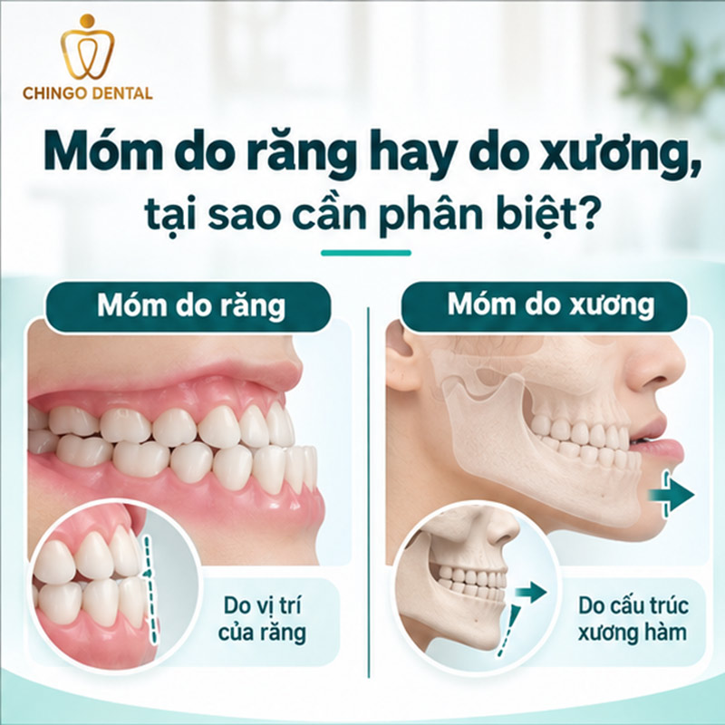 Niềng Răng Móm Trước Và Sau: Hình Ảnh Thực Tế & Quy Trình Đầy Đủ 2 hình ảnh răng móm