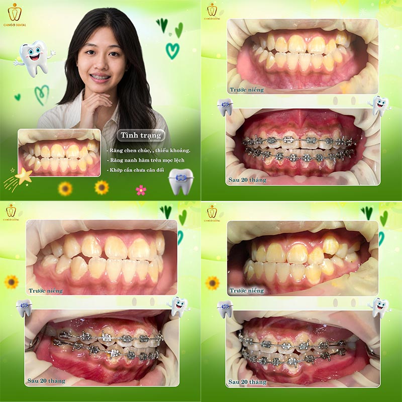 Niềng Răng Móm Trước Và Sau: Hình Ảnh Thực Tế & Quy Trình Đầy Đủ 3 hình ảnh sau niềng răng